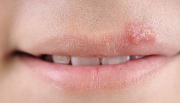 火气大、嘴唇长泡……怎样对付杀不死的唇疱疹病毒？