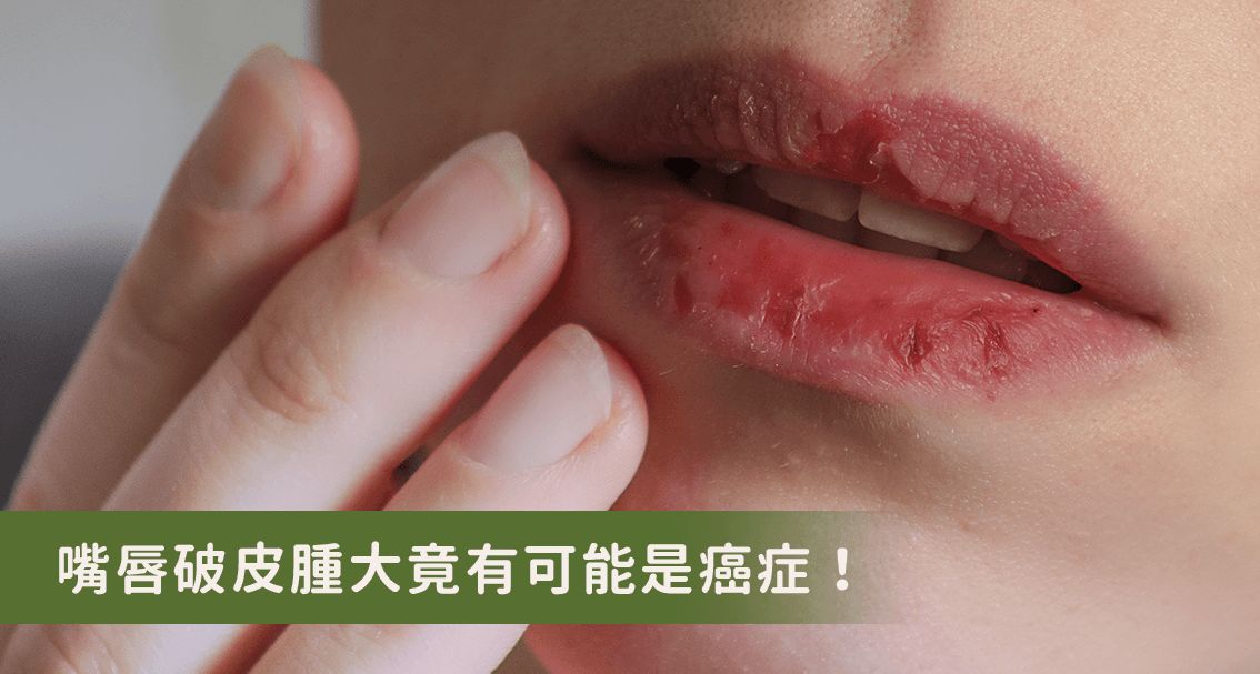嘴唇破皮肿大不是感染是癌症！医生：常晒伤的人要小心！
