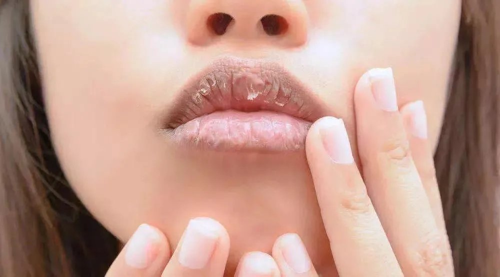 唇炎自救指南丨嘴巴上「唇皮林立」，到底怎么办？