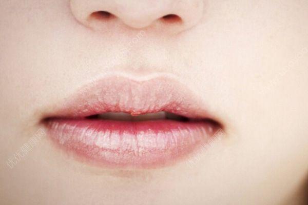 唇炎反复发作如何用药？