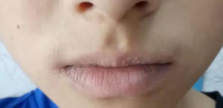 嘴唇发干是什么原因？