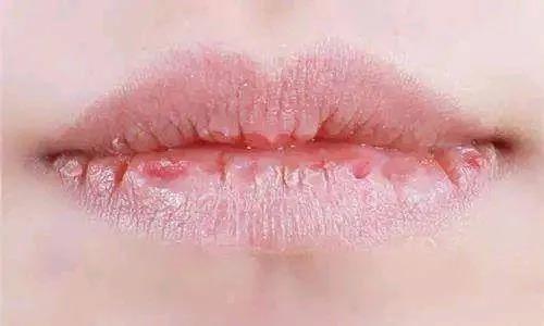 嘴唇干裂起皮，润唇膏用得越多越好吗？