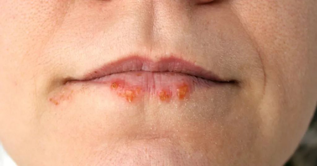 口周皮炎和唇炎有哪些区别