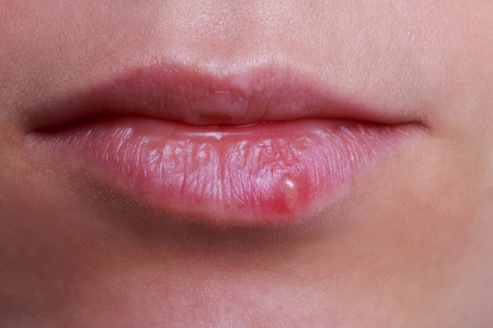 嘴唇上长疱疹是什么原因引起的（嘴唇上生了一簇密集小水泡）