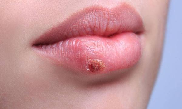 唇炎怎么治？治疗唇炎常用这14种方法！