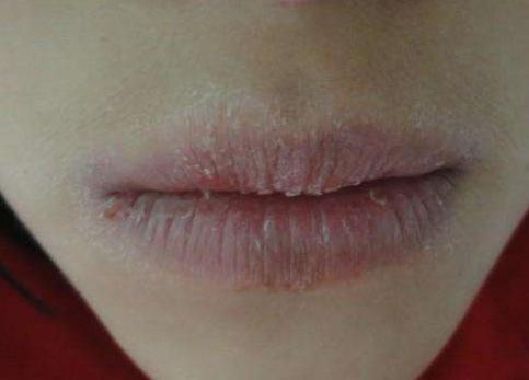 嘴唇有这几个症状，可能是慢性唇炎，经常性起皮干裂是症状一