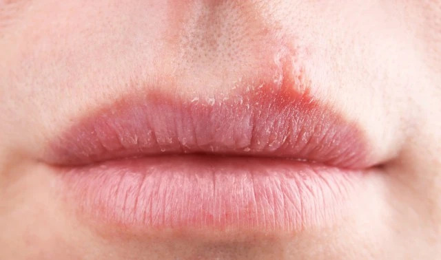 皮肤过敏嘴唇肿怎么治？