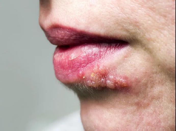 嘴起泡可能是感染了这种“病毒”，一朝感染终身复发