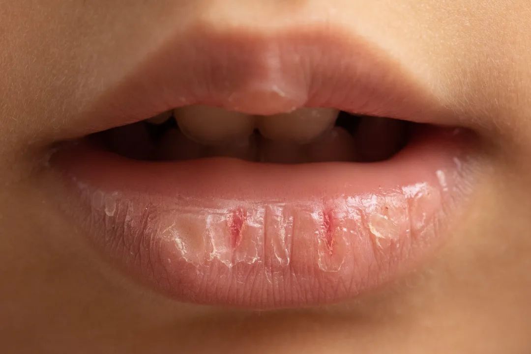 唇炎发作期间可以涂润唇膏吗？