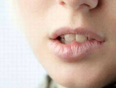 唇炎的食疗方法你都知道吗？