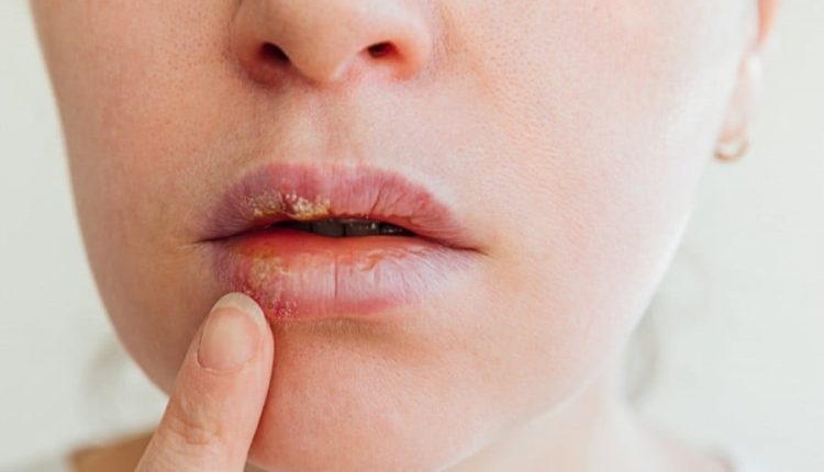新冠病毒感染后嘴唇起疱的治疗方法